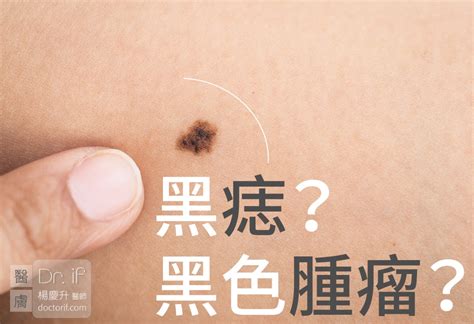 睪丸 黑痣|不大驚小怪！如何辨別「黑痣」與「黑色腫瘤」？ 